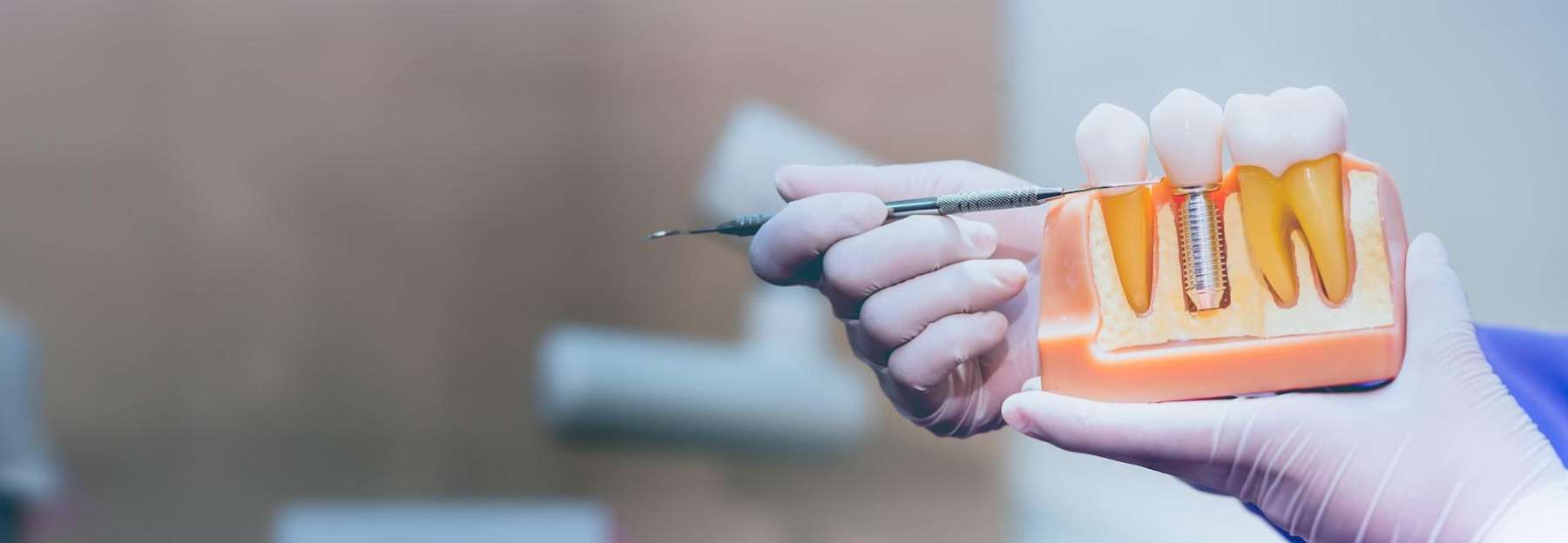Bone Grafting & Sinus Lifts | Dentist